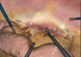 Simbionix LAP Mentor Laparoscopy Colorectal Module