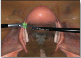 Simbionix LAP Mentor Laparoscopy Hysterectomy Module
